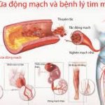 Bệnh lý tim mạch