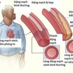 Hình ảnh động mạch vành