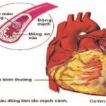 Nhồi máu cơ tim