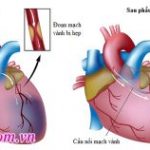Phẫu thuật bắc cầu động mạch vành