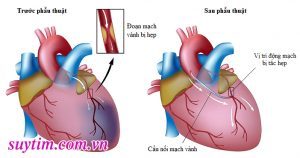 Phẫu thuật bắc cầu động mạch vành