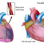 bắc cầu động mạch vành