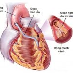 bắc cầu mạch vành