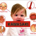 bệnh_kawasaki