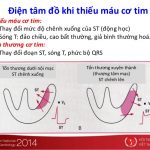 điện tâm đồ thiếu máu cơ tim